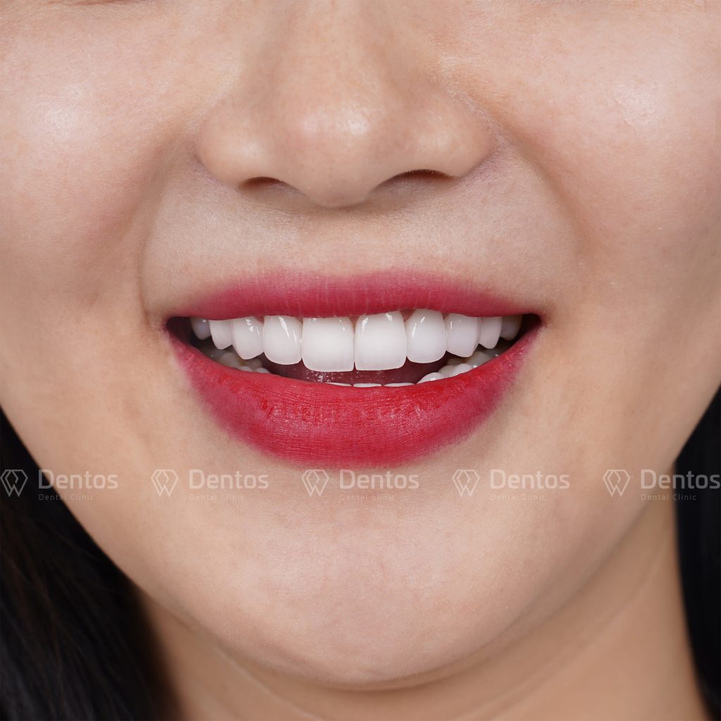 Dentos cam kết không đau, không mài nhỏ, ăn nhai hoàn toàn thoải mái